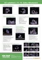 UZ vyšetření v 11. - 14. týdnu těhotenství